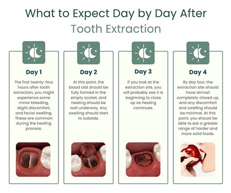 Things Needed for Tooth Extraction Recovery 的图像结果