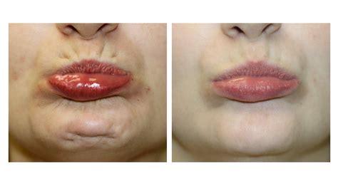 Image result for Chin Botox