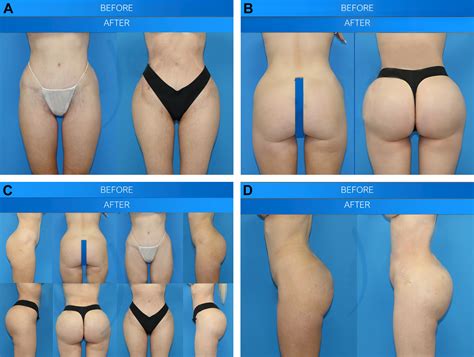 Combining Fat and Implants for Gluteal Augmentation - Clinics in Plastic Surgery