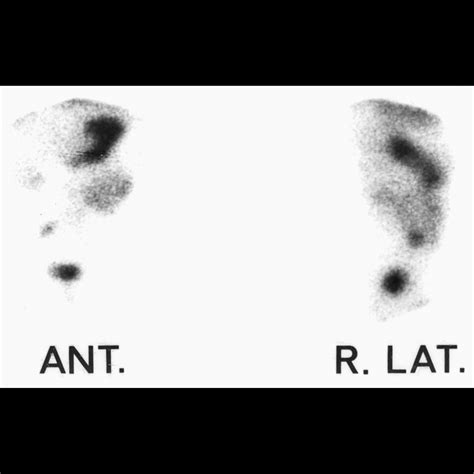 Meckel Diverticulum Scan
