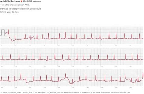 watchOS 5.2 brings critical ECG feature and more for Apple Watch: Here ...