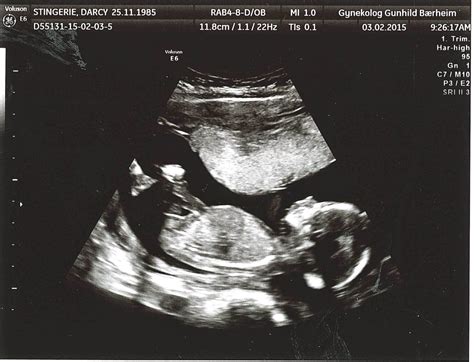 Baby Boy Ultrasound At 16 Weeks at Janet Simmons blog