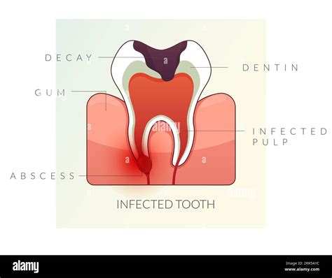 Infected Teeth - Root Canal Treatment - Stock Illustration as EPS 10 File Stock Vector Image ...
