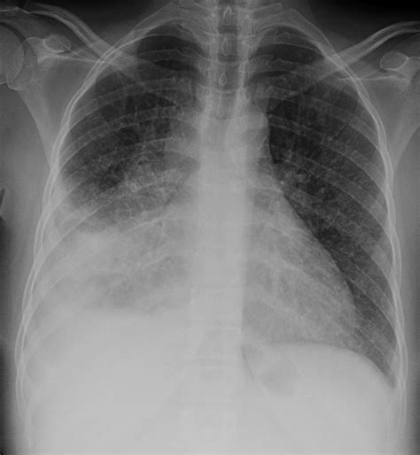 Multi-drug-resistant tuberculosis chest x ray - wikidoc