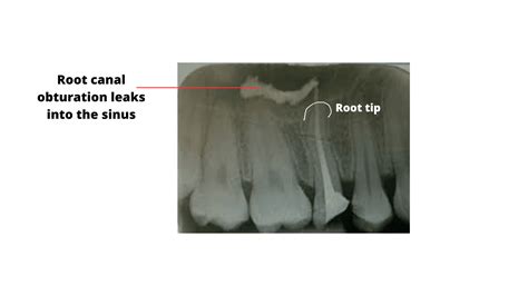 How can a failed root canal cause a sinus infection (X-ray pictures)?