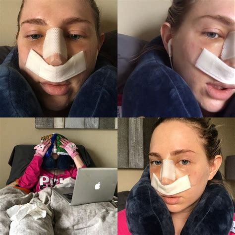 Nose Job: Surgery, Recovery, Cast Removal & Two Week Post-Op Reveal - Until The Very Trend Sinus ...