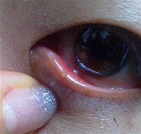 【眼科】眼皮红肿发痒是什么病的征兆 - YouTube