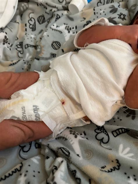 My Baby Umbilical Cord Is Bleeding at Carol Walsh blog