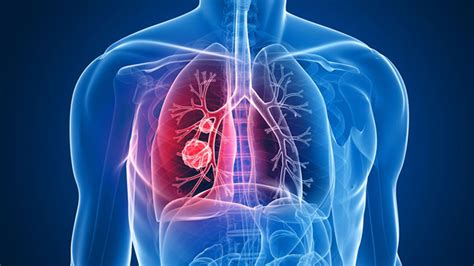 Three-Year Survival Update: Pembrolizumab Effective as First-Line ...