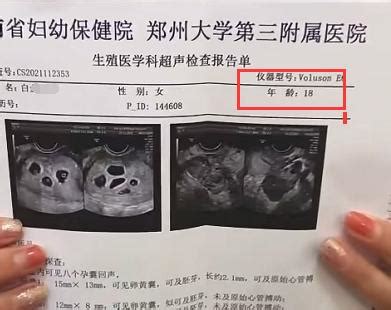 18岁女孩怀上8胞胎，受孕细节披露，打脸多少父母_澎湃新闻-The Paper