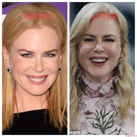 Nicole Kidman Plastic Surgery Face