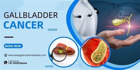 Image result for Gallbladder Cancer