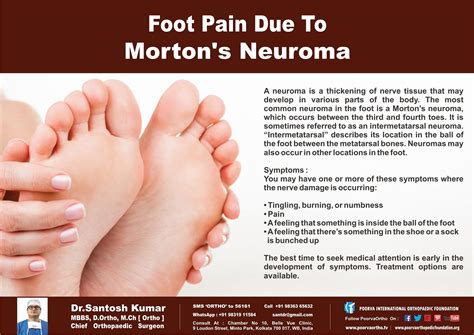 Foot Pain due to Morton's Neuroma. Know it. Check if you have these symptoms… in 2025 | Morton's ...