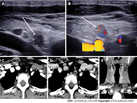 Parathyroid Tumor Ultrasound