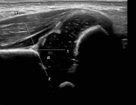 How to Perform Hip Ultrasound 的图像结果