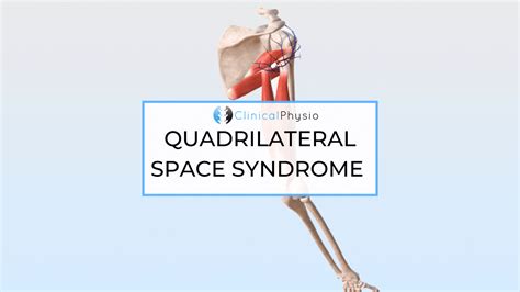 Quadrilateral Space Syndrome – Clinical Physio Membership