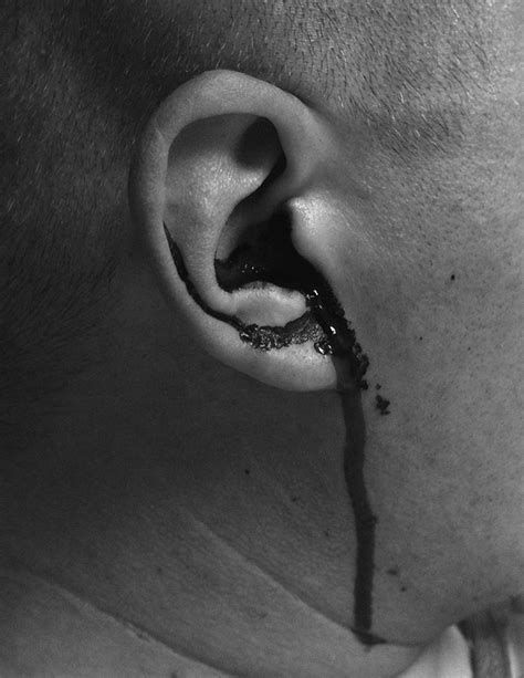 Otorrhagia after facial trauma | Emergency Medicine Journal