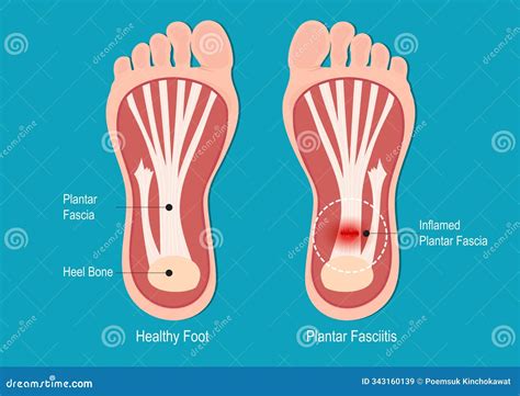 Plantar Fasciitis is One of the Most Common Orthopedic Stock Illustration - Illustration of ...