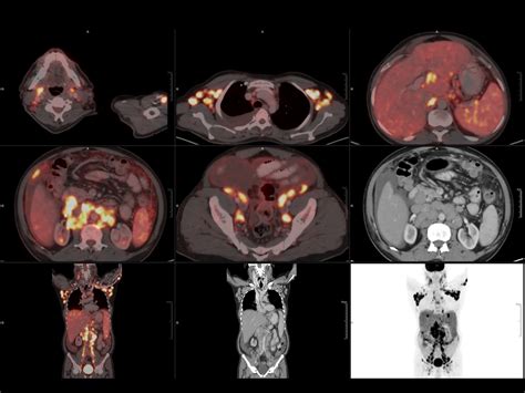 160 Slice Digital Pet-Ct – GIC Prime