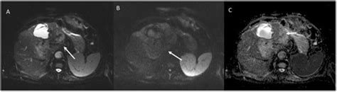 Risk Assessment and Cholangiocarcinoma: Diagnostic Management and ...