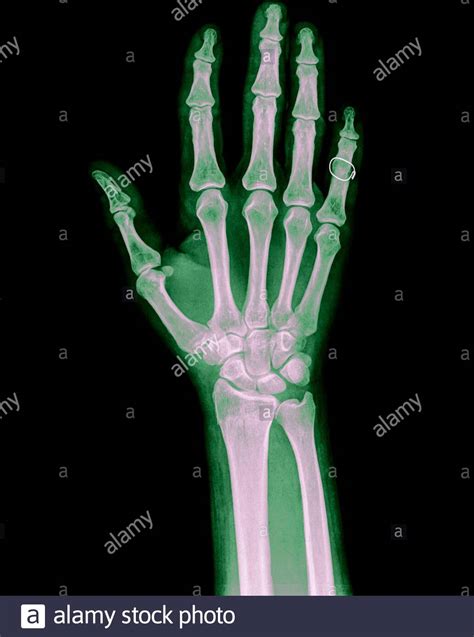 Xray Broken Hand
