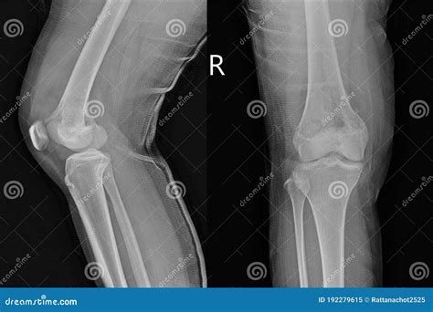 Osteosarcoma X Ray