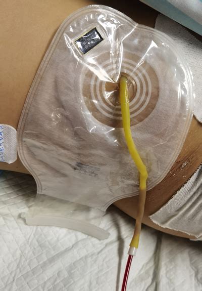 安徽网：术后引流液外渗，被这个医院护士的小发明解决了！