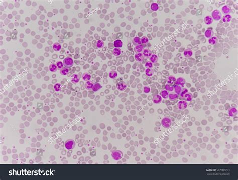 Band Neutrophils