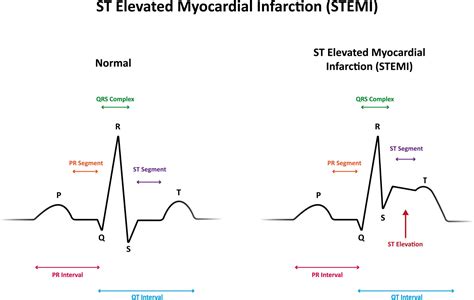 Interpreting a 12-Lead Electrocardiogram | 12-Lead ECG Resources | ACLS Certification Association