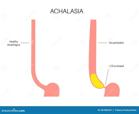 How To Diagnose Esophageal Achalasia at Jade Haylen blog