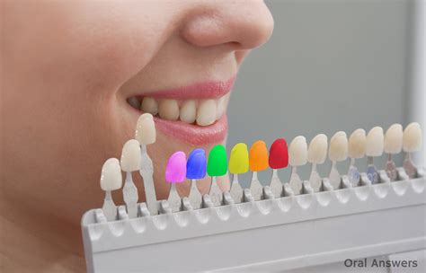 Colored Fillings | Oral Answers
