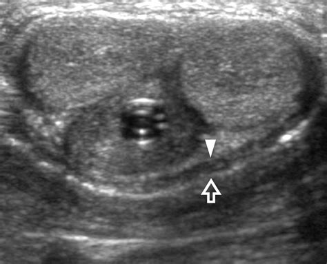 Nonpenetrating Penile Traumas: Sonographic and Doppler Features | AJR