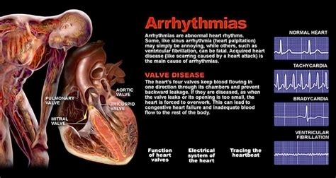 Arrhythmia Definition 的图像结果