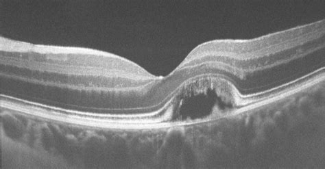 How Do OCT Devices for Glaucoma Compare?