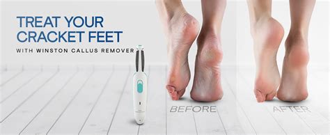 WINSTON Rechargeable Callus Remover for Feet with 2 Heads - 1 Year ...