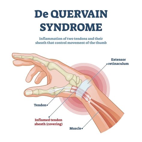 What are the symptoms of De Quervain’s tenosynovitis? | Orthopaedics Toronto - OrthoTO