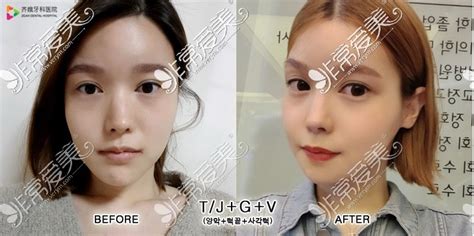双鄂正颌手术恢复后什么样？看齐娥牙科韩系女孩的案例对比！_韩国齐娥牙科医院-非常爱美网