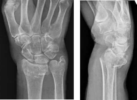A Patient’s Guide to Distal Radius Fractures — Dr. Nick Golinvaux