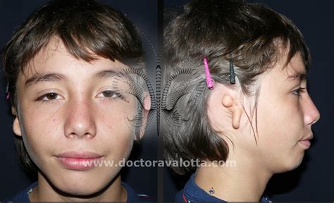 Mild Goldenhar Syndrome