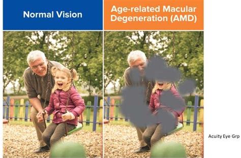 Image result for Macular Degeneration Vision Examples