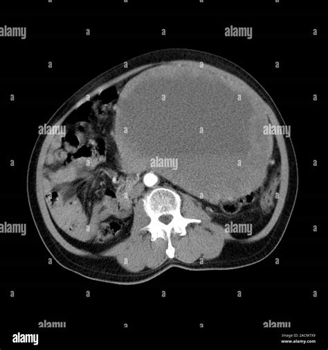 Abdominal sarcoma. Magnetic resonance imaging (MRI) scan of a malignant (cancerous) sarcoma ...