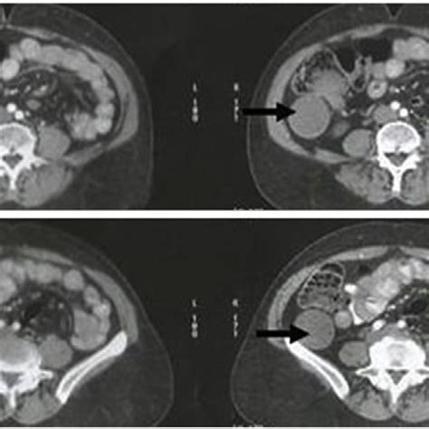 Image result for Normal Appendix Size