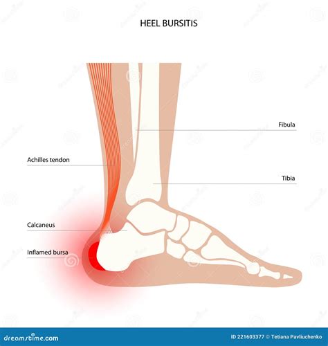 Bursitis Inflammation Concept Stock Vector - Illustration of bursectomy, arthritis: 221603377