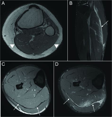 Connective tissue injury in calf muscle tears and return to play: MRI ...