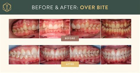 How To Fix An Overbite