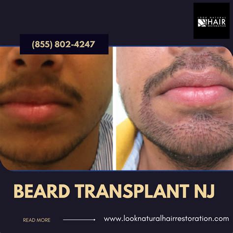 Top Beard Transplant In New Jersey - Look Natural Hair Restoration - Medium