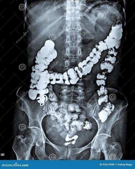 X Ray Of Abdomen With Large Intestine. Stock Image | CartoonDealer.com #92615989