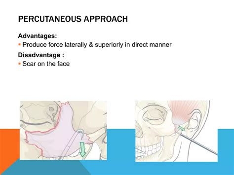 Management of zygomaticomaxillary complex fractures ih | PPTX