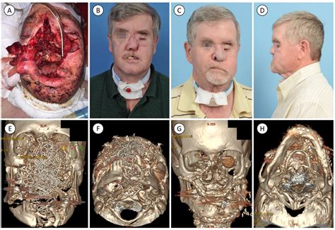 Facial Reconstruction Following Self-Inflicted Gunshot Wounds ...