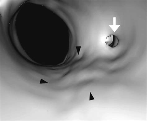Urethral Diverticulum: Diagnosis with Virtual CT Urethroscopy | AJR